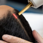 Alma Ted Laser hair restoration treatment for thinning hair