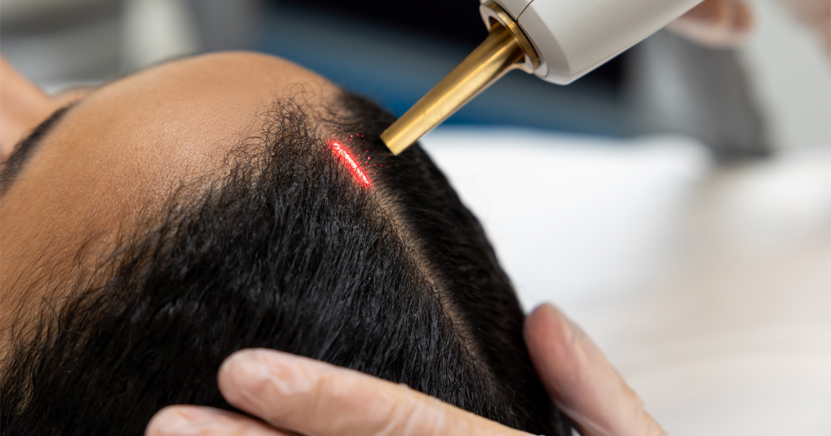 What Is Alma TED Laser Hair Restoration and How Does It Work?