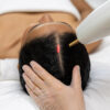 Alma TED laser hair restoration treatment for thinning hair and scalp health