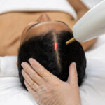 Alma TED laser hair restoration treatment for thinning hair and scalp health