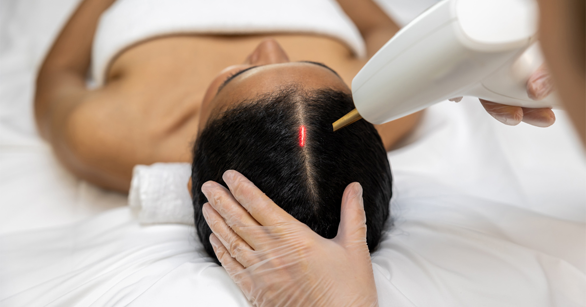 Alma TED laser hair restoration treatment for thinning hair and scalp health