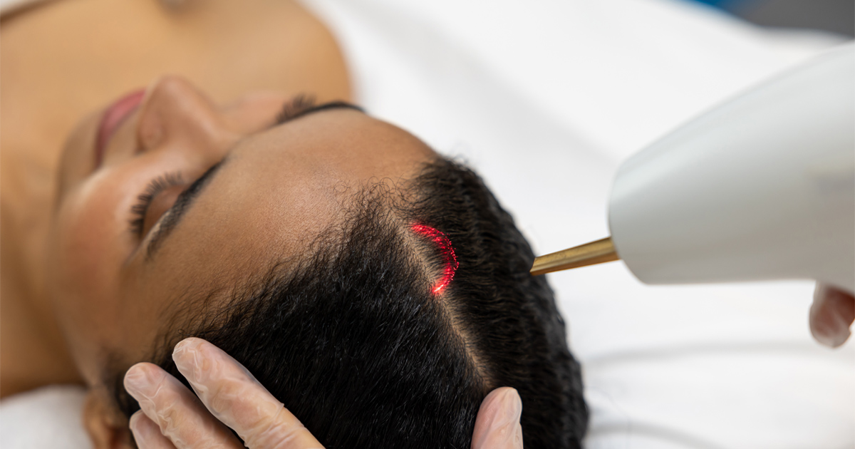 Alma TED Laser in Cincinnati OH supporting non-surgical hair restoration